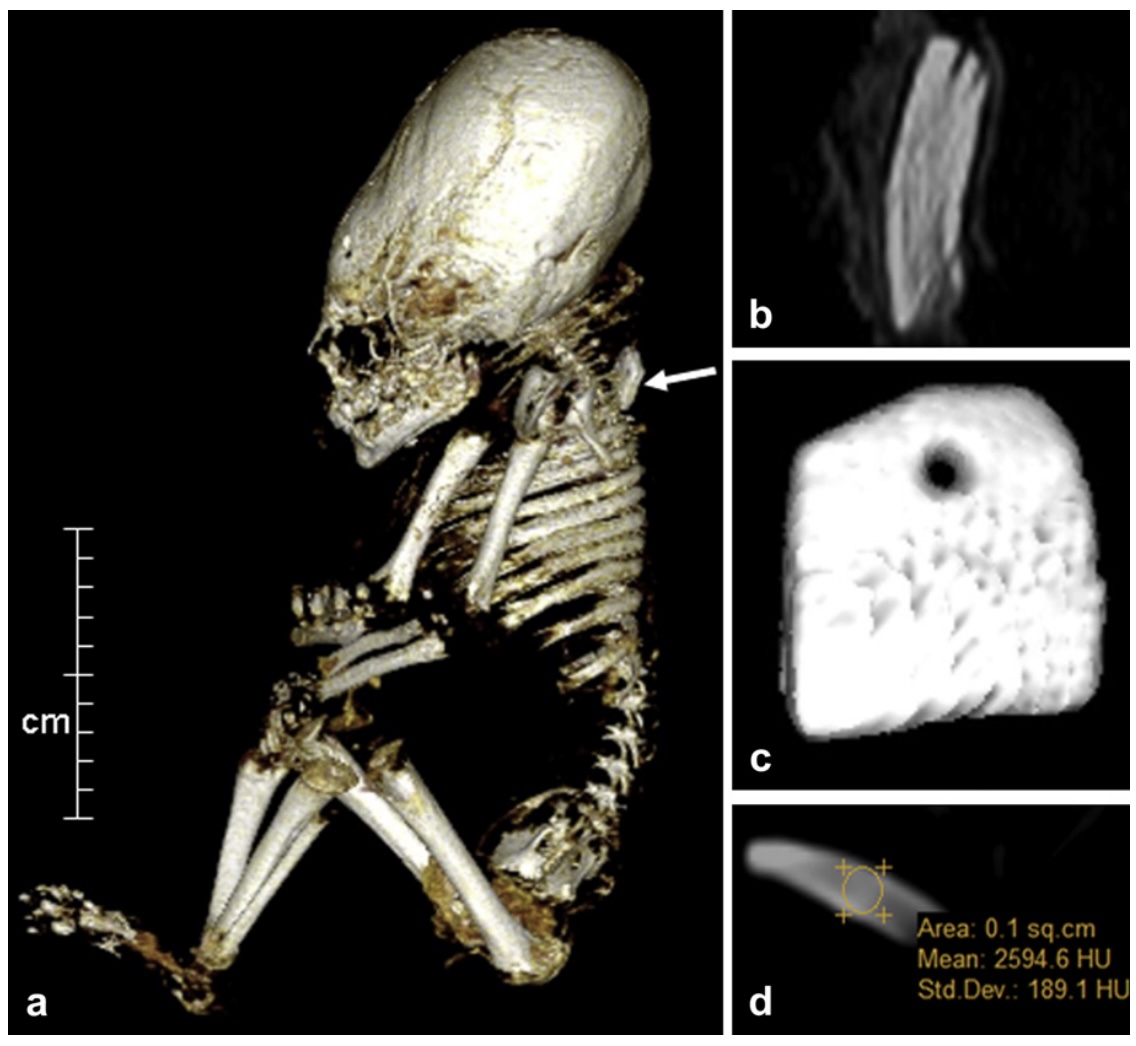 Radiological identification of foreign objects in mummified remains